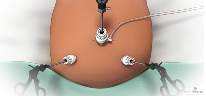 Laparoscopy surgery