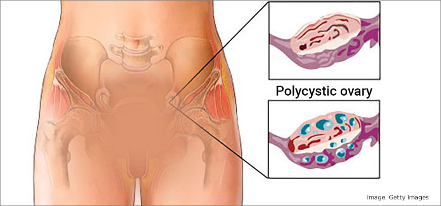 Polycystic Ovarian Disease